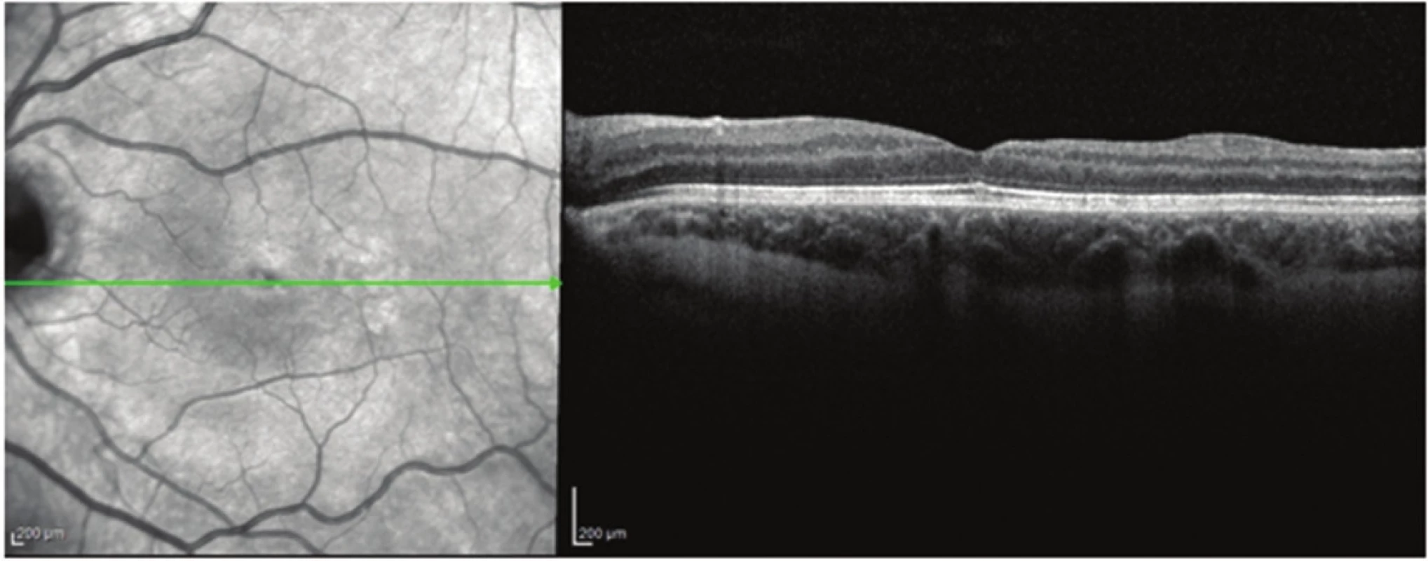 Patient no. 2 Linear horizontal transfoveolar OCT scan of LE after PPV, renewal of foveolar depression
