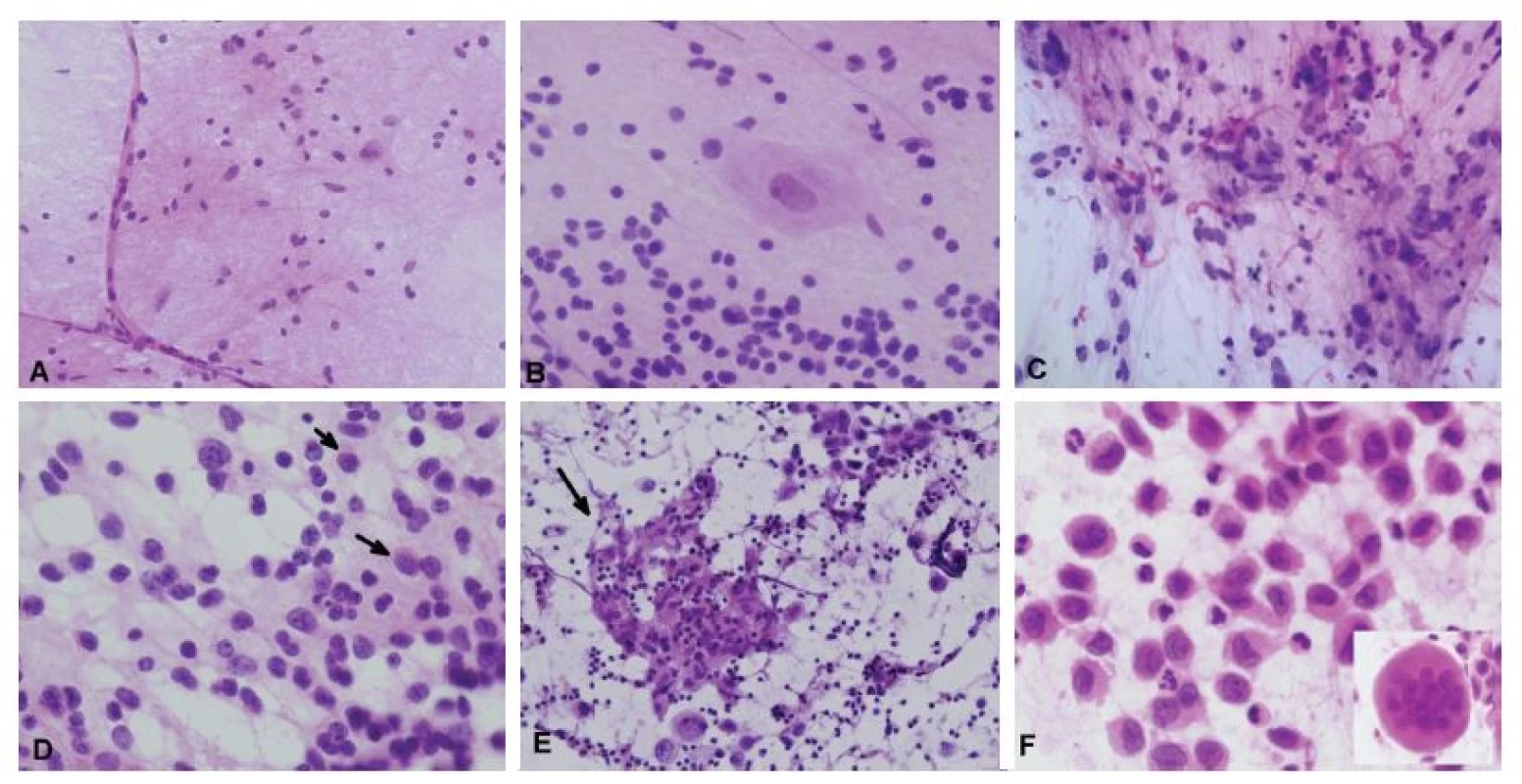 (A) 65-ročný muž, tumor frontoparietálne. V cytológii zachytené tenké kapiláry a mix blandných buniek – astrocytov, oligodendrocytov, mikroglie
a neurónov. Peroperačná a definitívna diagnóza: normálny kortex. V následnej stereotaktickej biopsii bol diagnostikovaný oligodendroglióm. (B) Normálny
mozoček v náterovej cytológii – jadrá neurónov granulárnej vrsvy sú na rozdiel od meduloblastómu alebo lymfómu menšie, monotónne, pravidelné, bez
mitóz alebo apoptóz (porovnaj s obr. 6D). Nález Purkyněho buniek podporuje „diagnózu“ normálneho mozočka. (C) V pilocytickom astrocytóme je bežná prítomnosť
viacjadrových a pleomorfných „atypických“ buniek. Početné Rosenthalove vlákna sú ale typické pre low-grade tumory. (D) Oligodendrogliómy majú
v náterovej cytológii takmer diskohezívny vzhľad, s početnými nahými jadrami, a aj keď je gliálnej matrix málo, gliálne výbežky je vo veľkom zväčšení možné
nájsť takmer vo všetkých prípadoch. Bunky majú okrúhle jadrá, „salt and pepper“ chromatín, charakteristická je prítomnosť tzv. minigemistocytov (šípky), ktoré
sa nevyskytujú v neurocytóme. Typické perinukleárne haló je fixačný artefakt, v cytológii neprítomný. (E) Biopsia tumoru v corpus callosum u 15-ročného
chlapca. V náterovej cytológii boli zachytené dyskohezívne atypické bunky s okrúhlymi jadrami s výraznými jadierkami a tenkým lemom cytoplazmy. V kombinácii
s epiteloidným granulómom (šípka) a lymfoidným pozadím je nález diagnostický pre seminóm (dysgerminóm). (F) Biopsia extraaxiálneho tumoru vo
frontotemporálnej oblasti u 10-ročného divčaťa, ktorý infiltroval podkožné mäkké tkanivá, kalvu a duru. V diskohezívnom nátere boli prítomné epiteloidné
bunky s výrazne poprehýbanými jadrami. Na pozadí početné neutrofily a eozinofily a ojedinelé mnohojadrové obrovské bunky (vložený obrázok). Peroperačná
a definitívna biopsia: Langerhans cell histiocytóza.