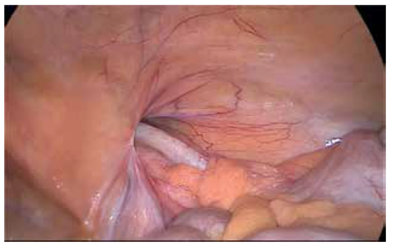 Příklad pacienta s inkarcerovanou pravostrannou
tříselnou kýlou obsahující appendix vermiformis<br>
Provedena laparoskopická appendektomie s TAPP kýly, viz
další obrázky<br>
Fig. 1. Example of a patient with incarcerated right inguinal
hernia containing appendix vermiformis<br>
We performed laparoscopic appendectomy with TAPP of the
hernia, see in the next pictures
