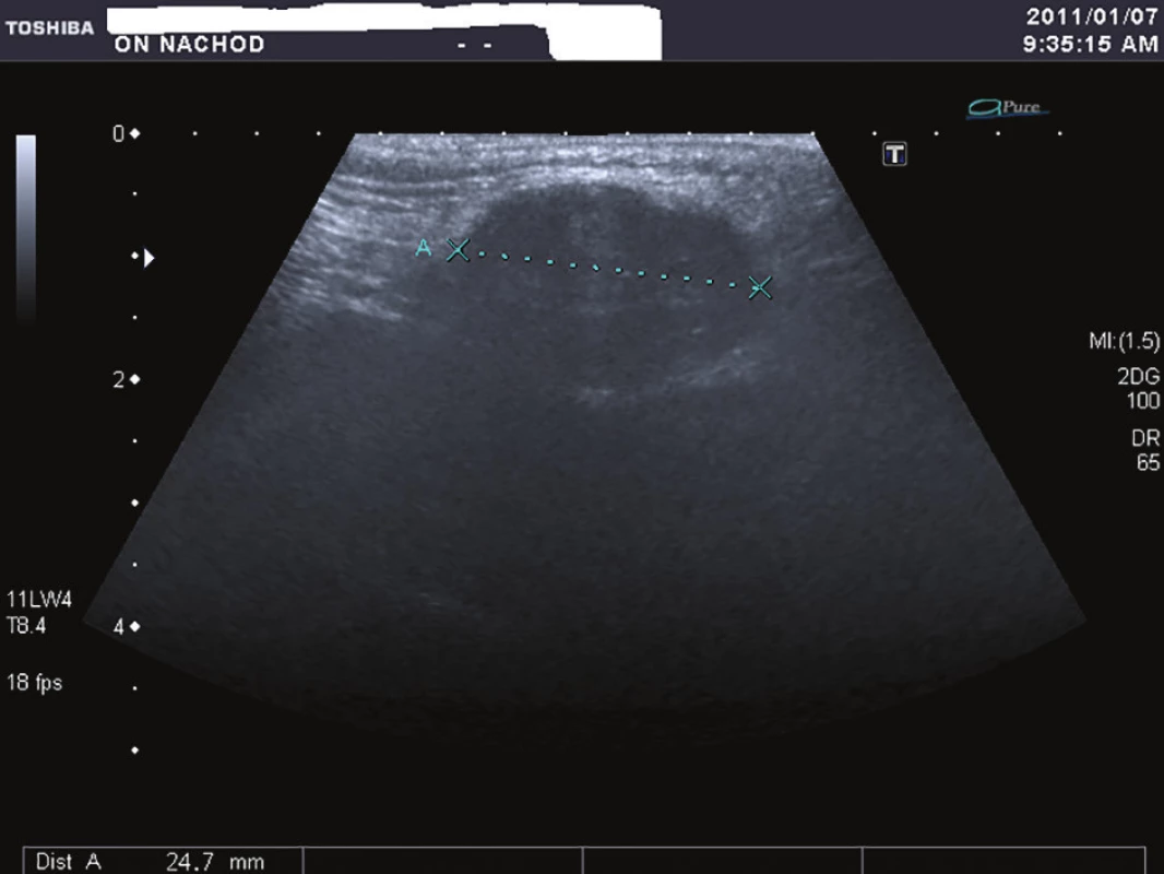 Ultrasonografie genitofemorální rýhy<br>
Fig. 1: Ultrasonography of the genitofemoral line
