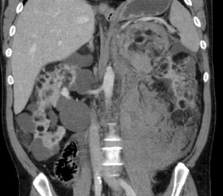 CT, koronární řez. Nemocný s tuberózní sklerózou. Ledviny prostoupeny mnohočetnými angiomyolipomy a cystami, v retroperitoneu vlevo pruhovité
zakrvácení<br>
Fig. 7. CT scan, coronal plane. Patient with tuberous
sclerosis. Kidneys with multiple angiomyolipomas and
cysts, a stripe of haemorrhage in the left retroperitoneum
