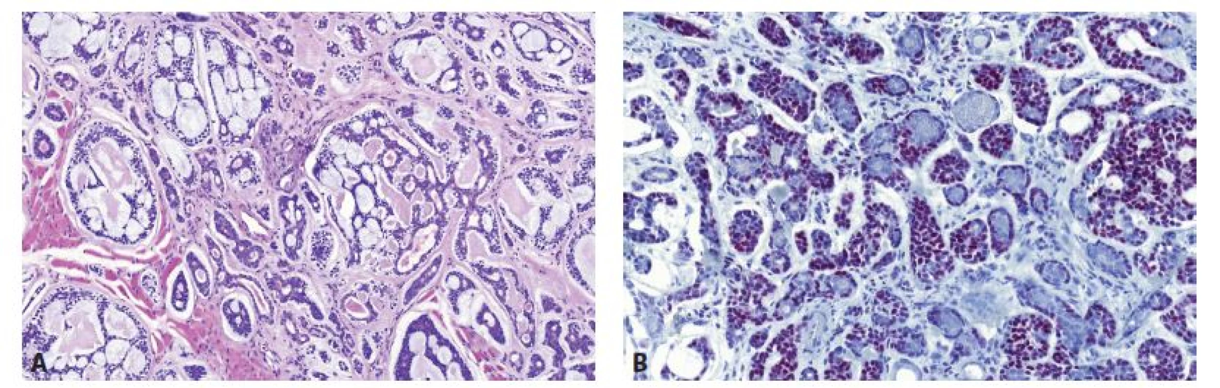 A. Typická histologická struktura AdCC s převahou kribriformních a pseudocystických struktur, HE barvení, zvětšení 200x.
B. Imunohistochemická exprese MYB s nukleární pozitivitou, zvětšení 200x.