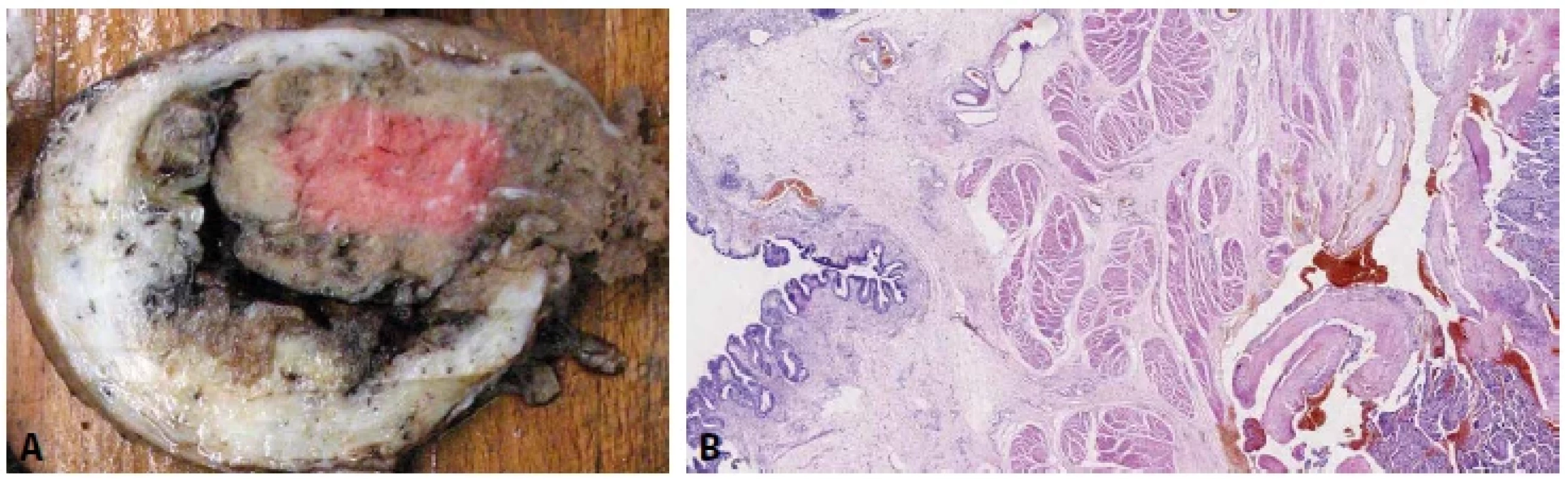 A: Placenta percreta. Prorůstání placenty přes serózní povrch dělohy. B: Placenta percreta. Prorůstání placenty do stěny močového měchýře
(grade 3b dle klasifikace FIGO, 2019) (HE, 20x).