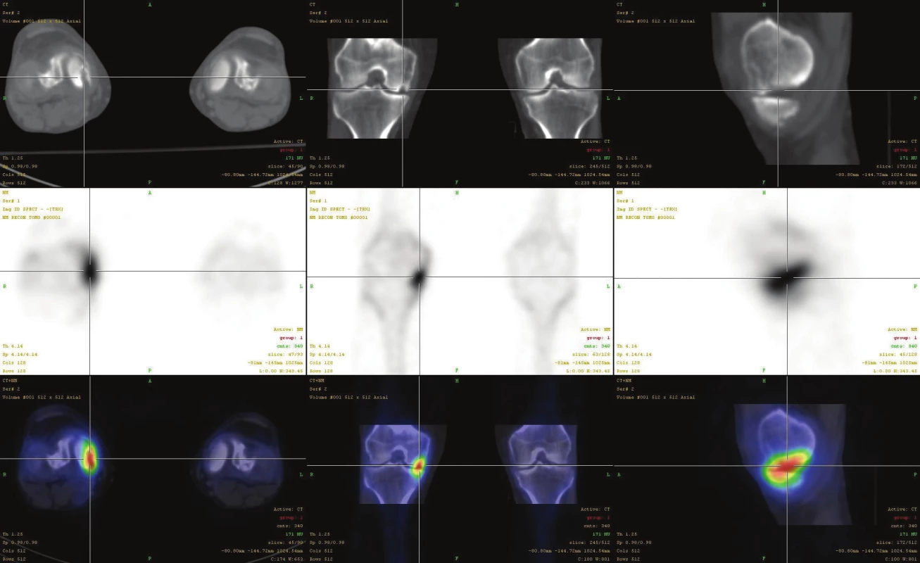 Fúze SPECT/CT obrazu u pacienta s osteochondrálním defektem mediálního kondylu femuru v pozdějším stádiu a s přestavbovou
aktivitou i protilehlého konce tibie. V horní řadě je obraz z LDCT postupně v transaxiální, koronární a sagitální rovině. Střední řada ukazuje
odpovídající SPECT řezy. Dolní řada prezentuje odpovídající fúzované SPECT/CT řezy. Scintigrafický nález v pozdějších stádiích nemusí
být výrazný, nález na LDCT je typický.