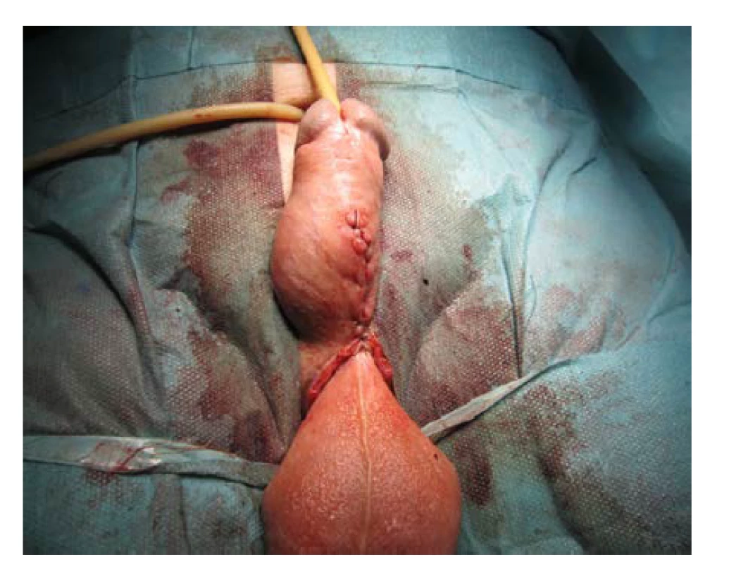 Finální stav po sutuře podkoží a kůže<br>
Fig. 19. The final state after the subcutis and skin were
sutured
