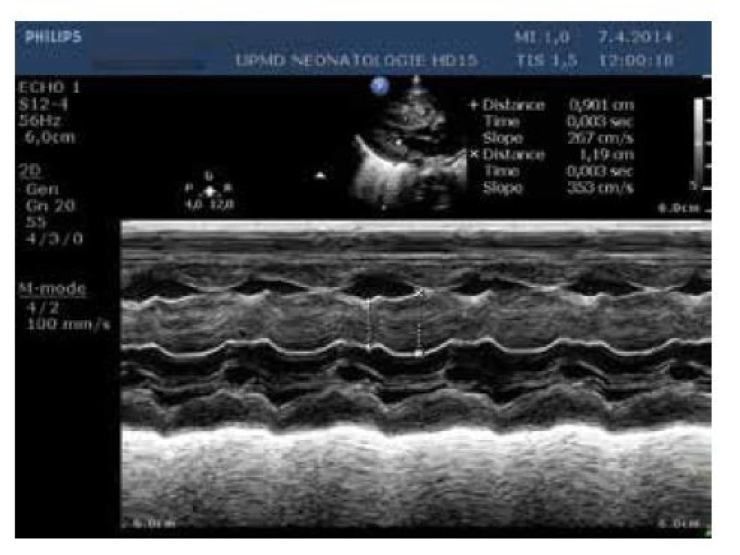 Echokardiografie, M-mode levé komory, hypertrofie
myokardu, měření šíře komorového septa v systole a diastole
(pacient po čtyřdenním podávání hydrokortizonu)