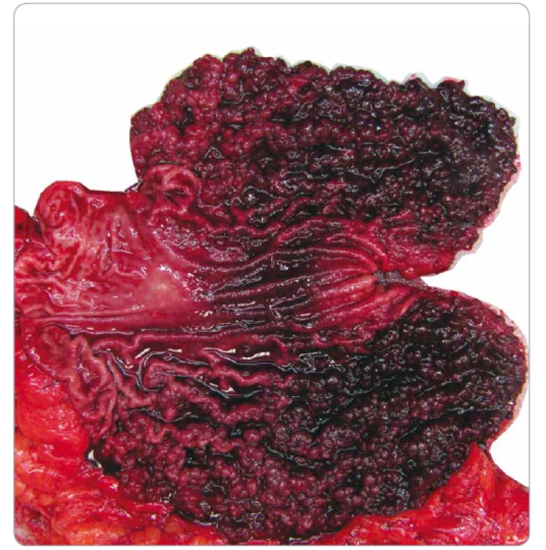 Gastric adenocarcinoma and proximal polyposis of the stomach – stomach resection
along with omentum (Masaryk Memorial Cancer Institute).