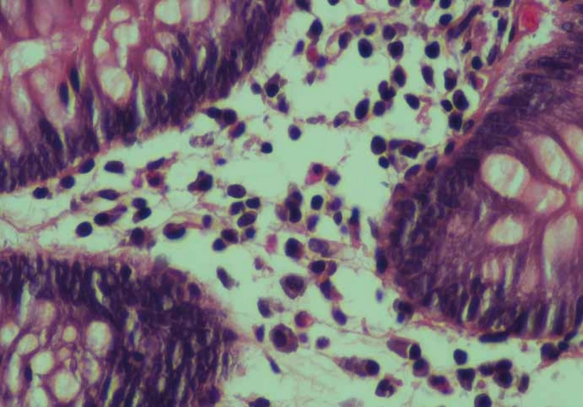 Detail zánětlivé celulizace v lamina propria střevní sliznice s mastocyty (barvení hematoxylin-eozinem, zvětšení 60×).<br>
Fig. 1. Detail of the colon mucosa with increased inflammatory cells in the lamina
propria with mast cells (Haematoxylin and eosin staining, enlargement 60×).
