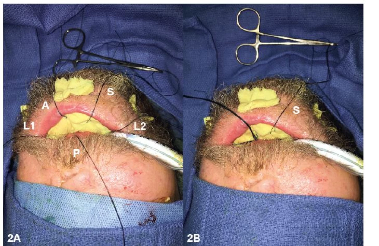 (A, B) Securing of the intraoral bolster. The bolster was placed over the graft, and the ends of the 2-0 silk ties were tied in the
middle of the bolster. A safety suture (S) remained outside of the oral cavity for ease of removal in the case of bolster dislodgement
and airway compromise