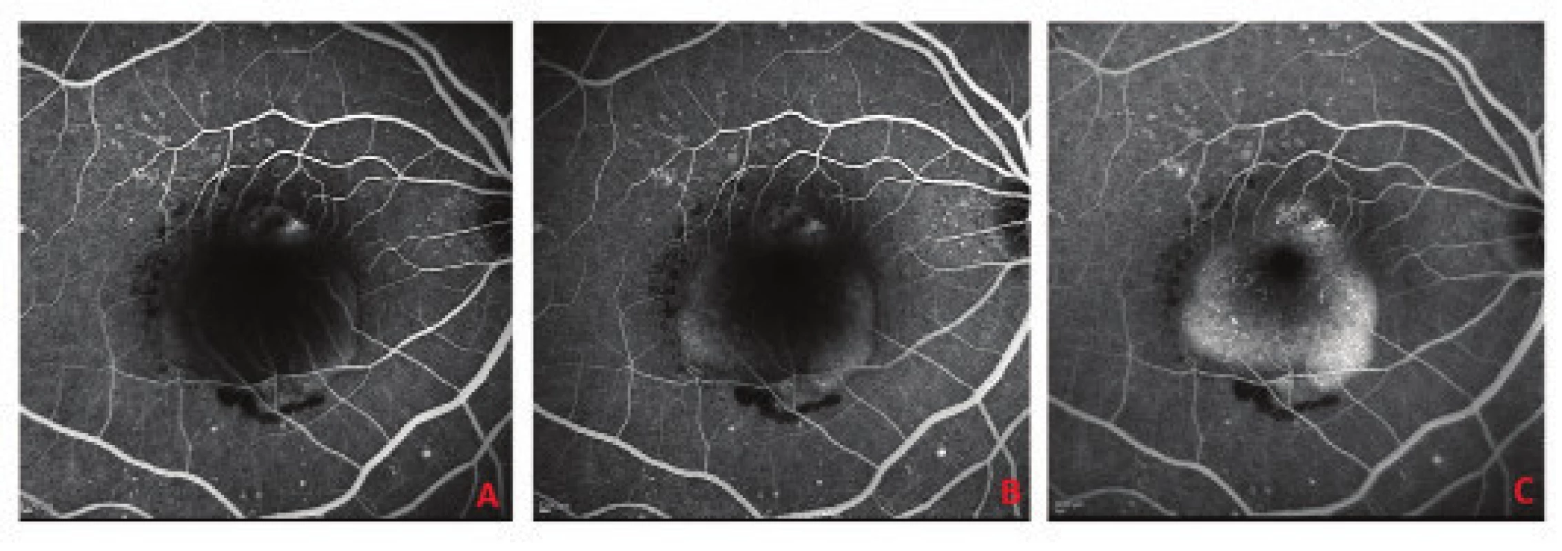 Fluorescence angiography at baseline examination<br>
A. Early phase of fluorescence angiography identifying hyperfluorescent lesion of choroidal neovascularisation with infiltration on the upper edge of the lesion, peripheral filling of RPE detachment, on
lower edge evident hypofluorescence corresponding to haemorrhage<br>
B. Middle phase with progressive filling of deposit of RPE detachment with fluorescein<br>
C. Late phase identifying homogeneous hyperfluorescence with sharp edges