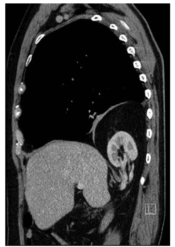 Sagitální řez <br>
Fig. 6. Sagital section