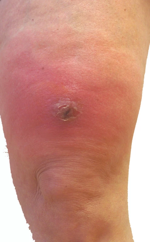 Celulitida bérce s abscesem<br>
Nepravidelné ohraničení zánětu.