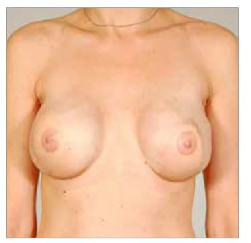 Fig. 8. Patient No. 4 – final result
of healed LDM flaps bilateral
application, nipple-areolar complex
reconstruction and implants.