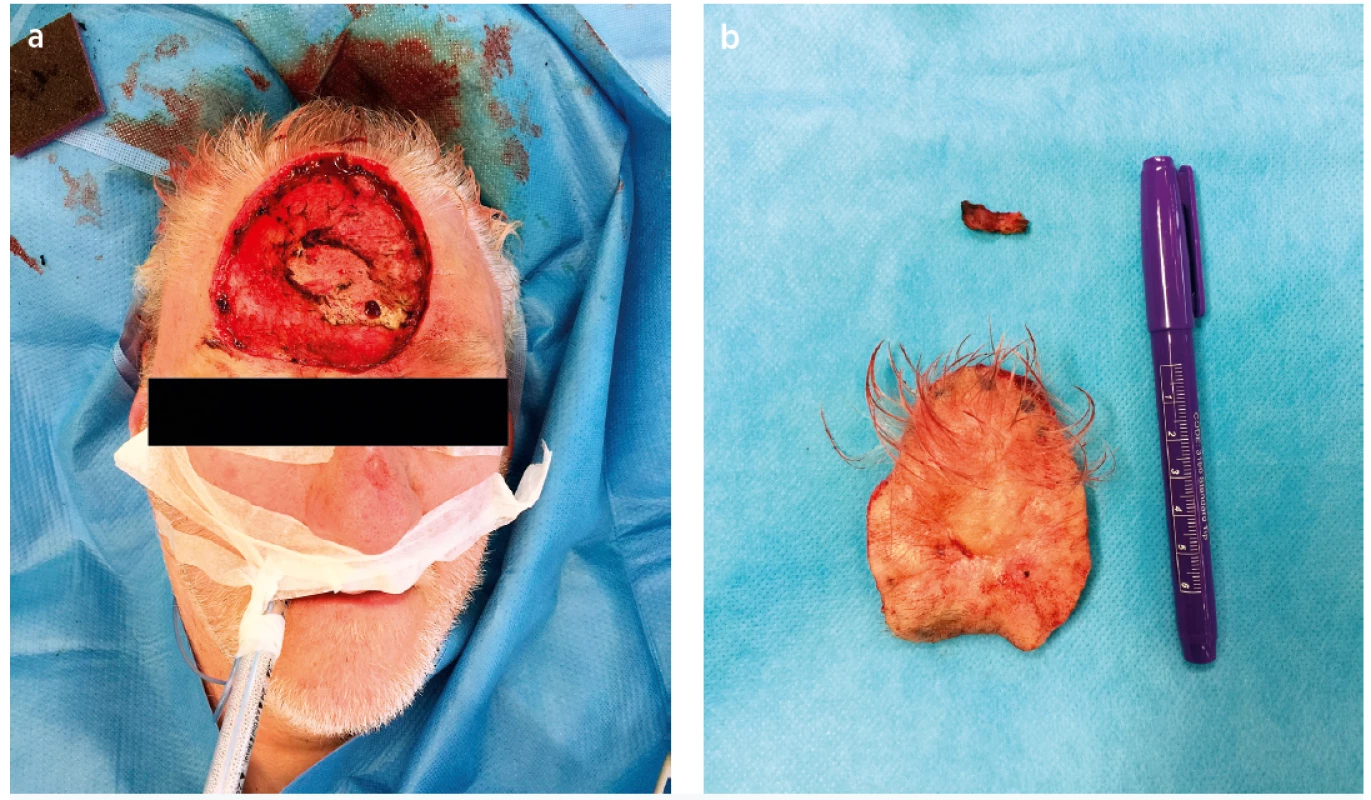 a. Perioperative state, wide and radical local excision of the lesion with >1cm peripheral margins<br>
Fig. 2. b. Resection specimen (7.5 x 6.0 x 0.8 cm)