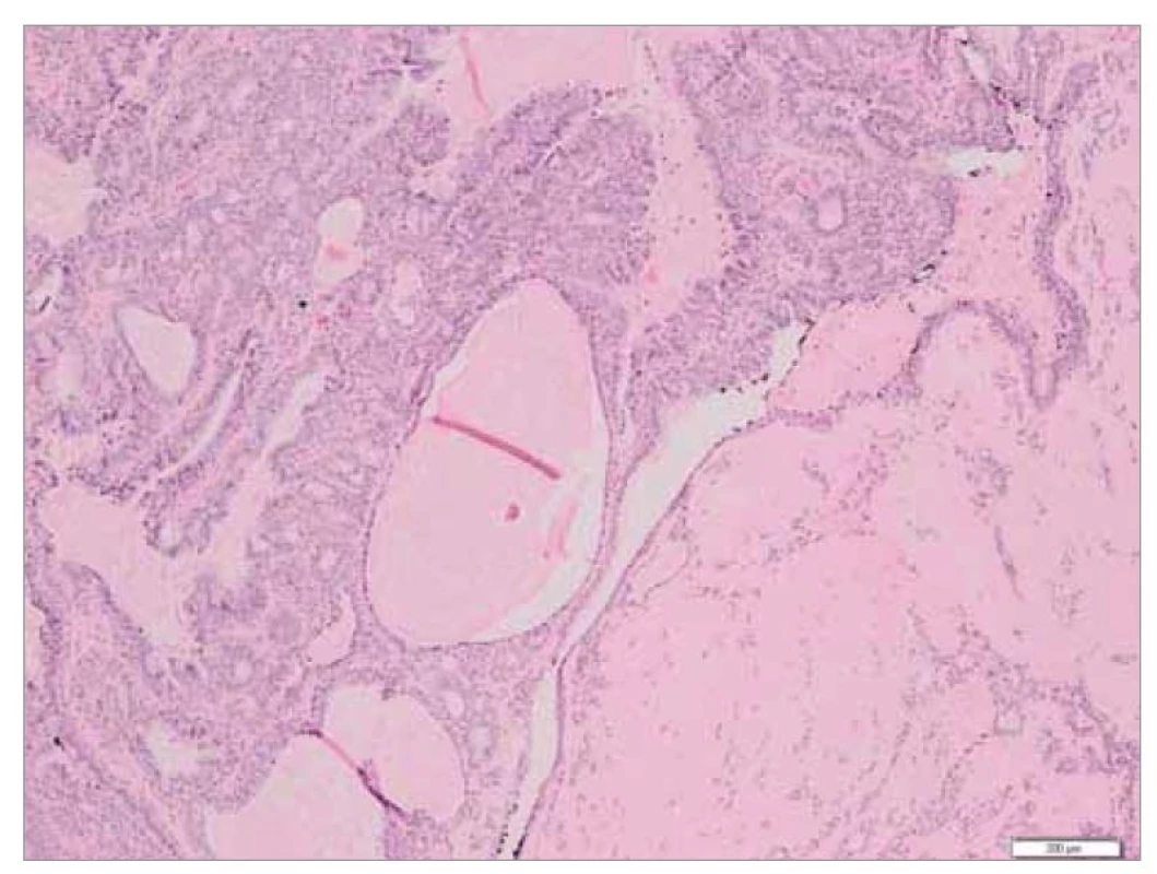 Histopatologický obraz epitelio-myoepiteliálního karcinomu, neoplastická
populace tvořena tubulárně utvářenými strukturami s bifázickým vzhledem
– v periferii tubulů myoepitelovými buňkami, v luminální části epitelovými
buňkami, barvení HE (zvětšení 40x).<br>
Fig. 2. Histopathological picture of epithelio-myoepithelial carcinoma, neoplastic
population formed by tubularly formed structures with biphasic appearance – in
the periphery of the tubules by myoepithelial cells, in the luminal part by epithelial
cells, HE staining (magnification 40x).