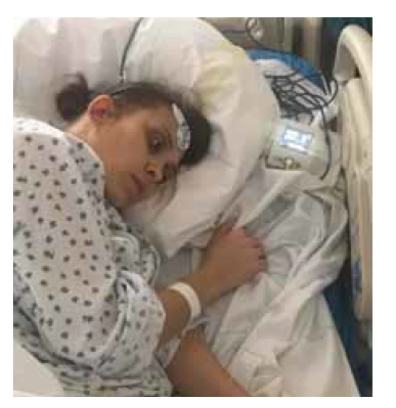 Intrapartální monitorace teploty
pomocí 3M Spot On systému
(foto se souhlasem pacientky).<br>
Fig. 1. Intrapartum temperature monitoring
via 3M Spot On system (photo
with the patient's consent).