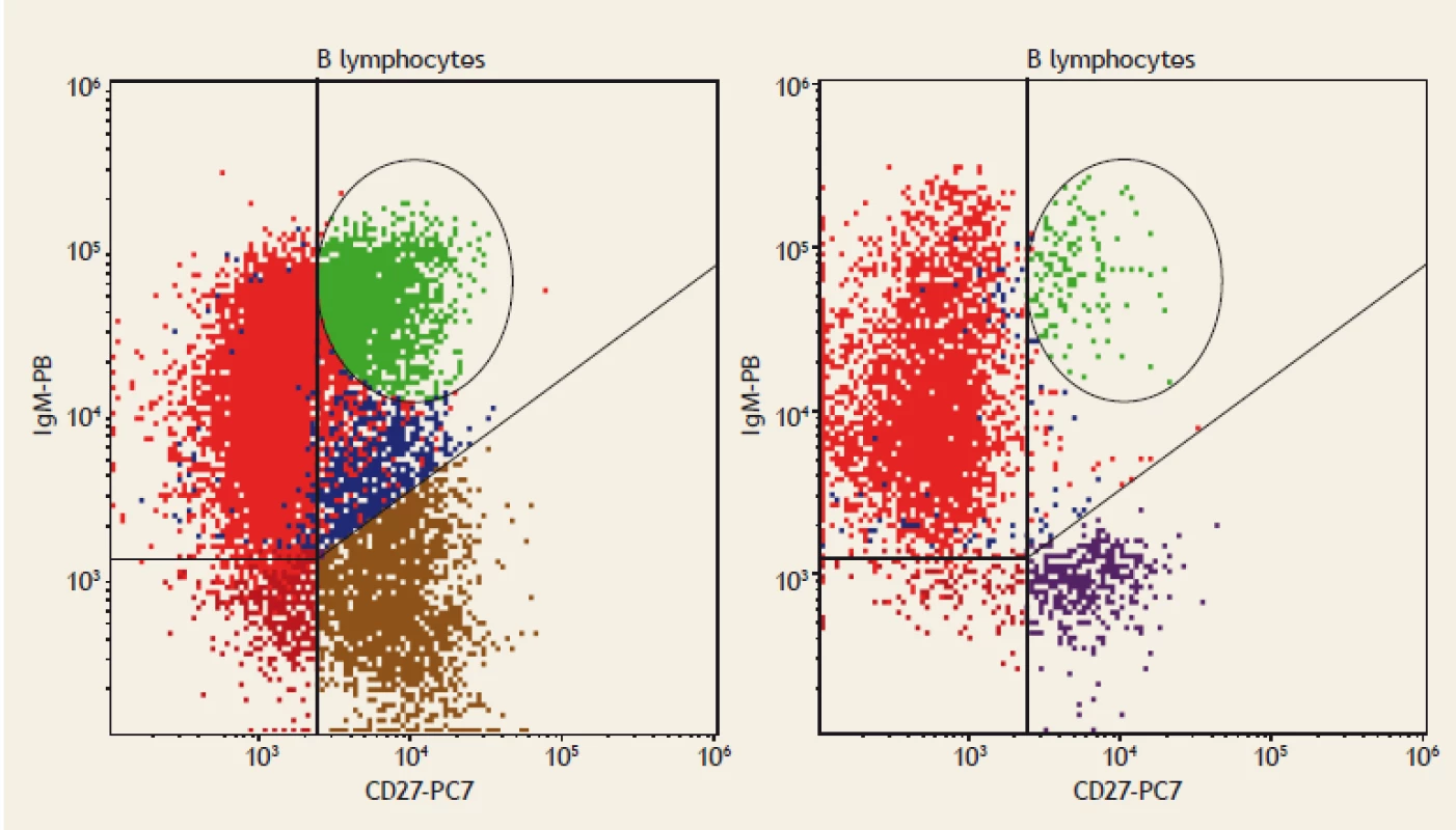 Flow cytometry. IgM+ memory B lymphocytes (CD19+CD27+IgM++), displayed as green dots. On the left:
a healthy blood donor; IgM+ memory B lymphocytes comprise 2% of all B lymphocytes. On the right: a patient with
coeliac disease; IgM+ memory B lymphocytes comprise 0.5% of all B lymphocytes.<br>
Obr. 1. Průtoková cytometrie. IgM+ paměťové B lymfocyty (CD19+CD27+IgM++), zobrazeny jako zelené tečky. Vlevo: zdravý
dárce krve; IgM+ paměťové B lymfocyty tvoří 3 % všech B lymfocytů. Vpravo: pacient s celiakií; IgM+ paměťové B lymfocyty
tvoří 0,5 % všech B lymfocytů.
