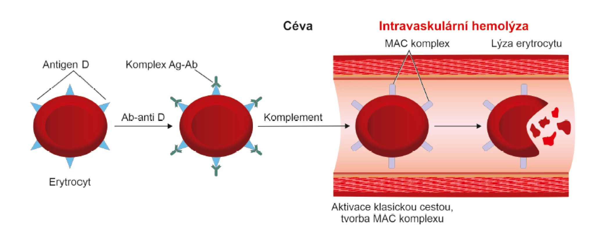 Cytotoxicita zprostředkovaná komplementem (aktivace komplementu klasickou cestou)