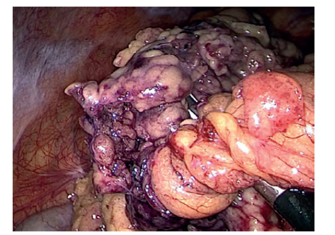 Vizualizace místa torze omenta<br>
Fig. 3: Visualization of the site of omental torsion