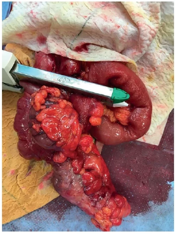 Ileocekální resekát pro mukokélu appendixu –
náhodný nález při apendektomii pro suspektní akutní
apendicitidu <br> 
Fig. 3. Ileocecal resection for appendiceal mucocele – incidental
finding during appendectomy for suspected acute
appendicitis