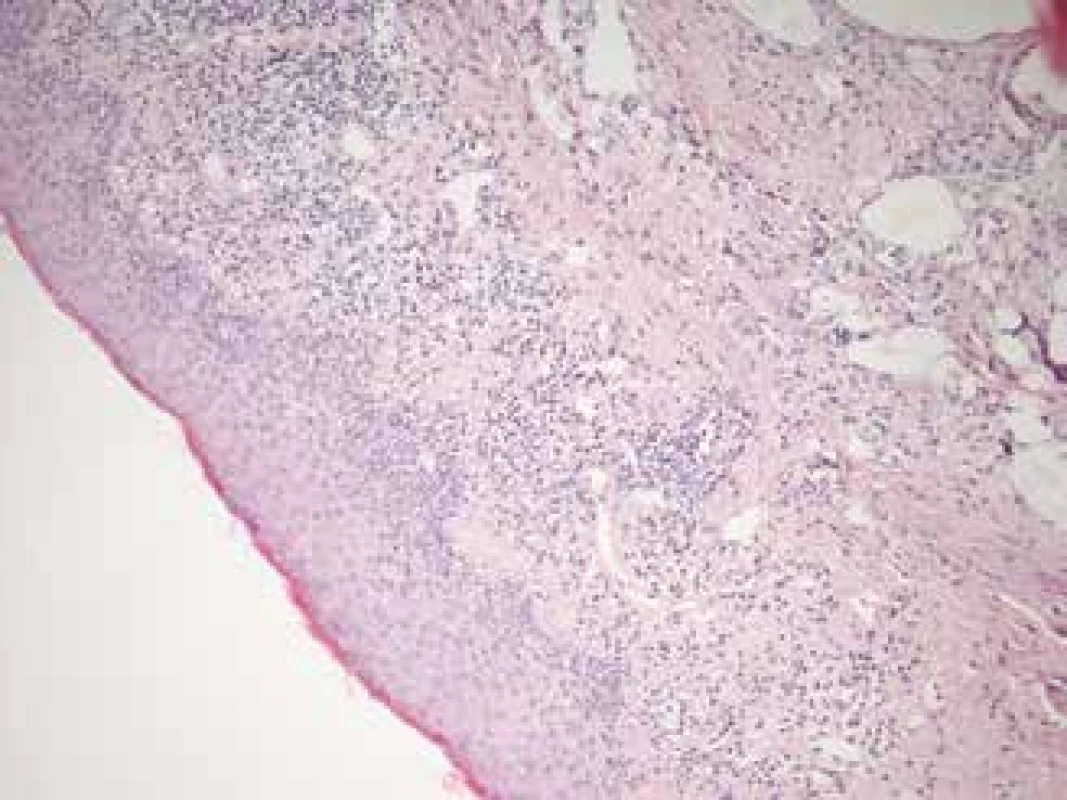 Histological sample from edge of left eyelid, taken
during partial tarsorrhaphy in 2017. Similar histological
features attesting to lichenoid changes as in fig. 1, with
lymphocytic infiltration of subepithelial conjunctiva