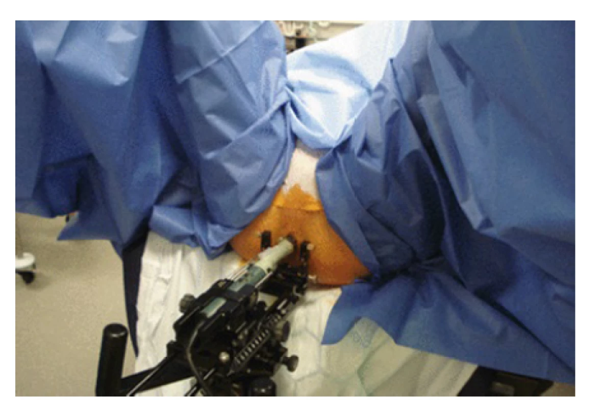 Použití stepperu při transperineální biopsii
prostaty (https://radiologykey.com/template-
-mapping-biopsies-an-overview-of-technique-and-
-results)<br>
Fig. 4. Usage of stepper arm during transperineal
prostaty biopsy (https://radiologykey.com/template-
-mapping-biopsies-an-overview-of-technique-and-
-results)