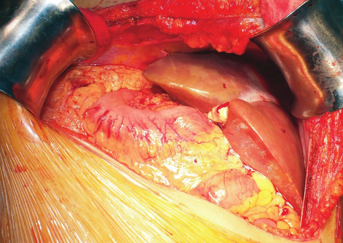 Probatory placement of the rotated reduced graft
in the hepatic fossa<br>
The resection plane is located under the diaphragm; the left
lateral segment points to the left hypogastrium. The picture
was taken before reperfusion of the graft.