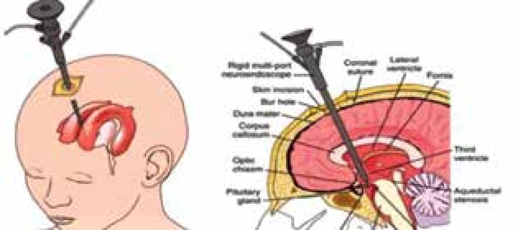 Princip endoskopické ventrikulocisternostomie
třetí komory<br>
Fig. 2: Endoscopic third ventriculostomy
