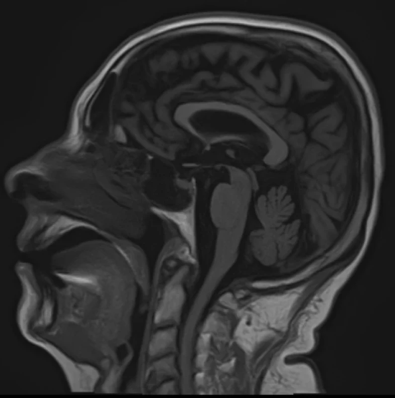 Brain MRI. Sagittal T1 weighted – normal structures of brainstem and corpus callosum. <br>
Obr. 3. MR mozku. Sagitální T1 vážený snímek – normální struktury mozkové kmene a corpus callosum.

