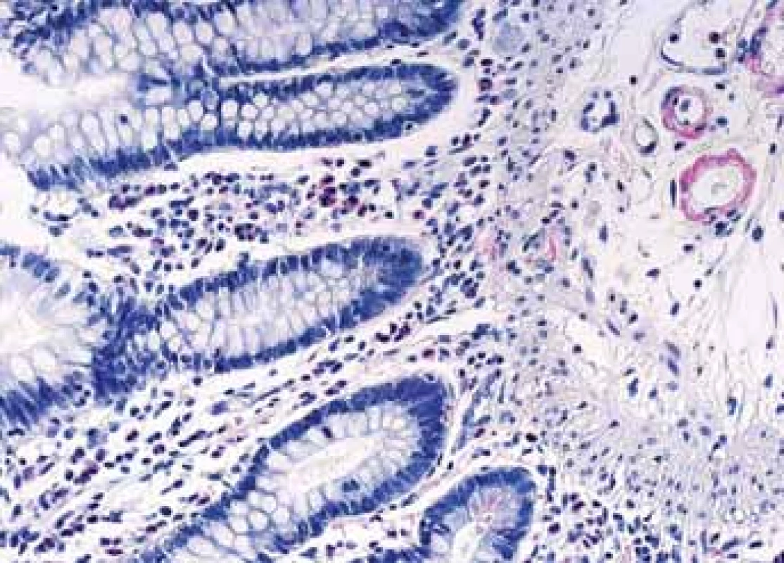 Histologické nálezy u pacientů s IBD a renálním postižením (tubulointersticiální nefritida, glomerulonefritida, AA amyloidóza).<br>
Fig. 7. Biopsy pictures in IBD patients with renal illness
(tubulointerstitial nephritis, glomerulonephritis,
AA amyloidosis).