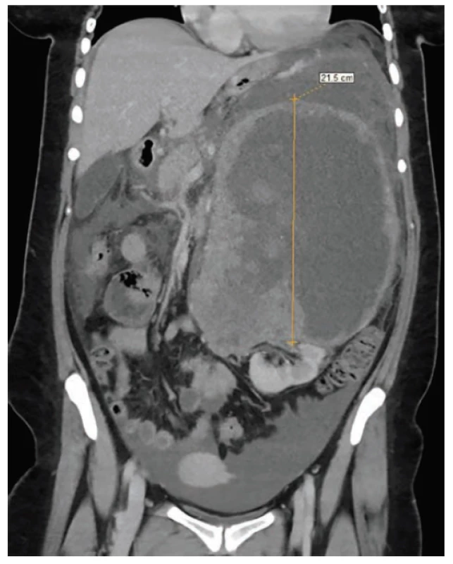 Computed tomography of an abdomen : a huge
retroperitoneal tumor with a fluid in peritonel cavity