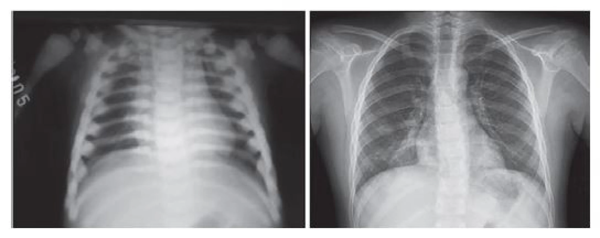 Srovnání rentgenového nálezu u chlapce s MIOP v době
stanovení diagnózy a 8 let po transplantaci