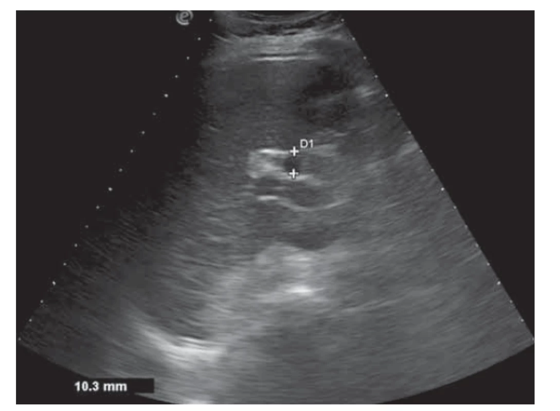 USG nález dilatácie ductus choledochus (pred zahájením
liečby).<br>
Fig. 2. USG finding of dilatation of common bile duct
(before treatment).