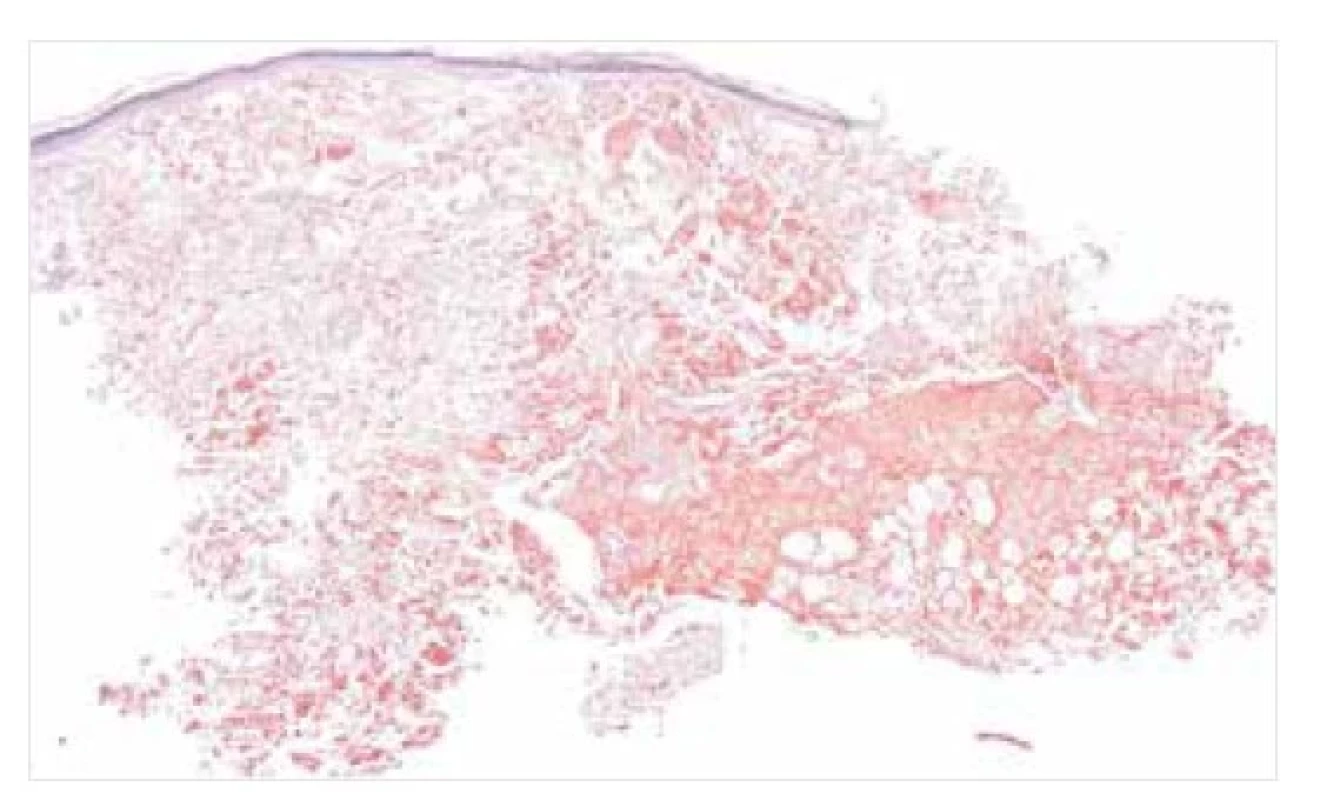 Nodulární amyloidóza – histopatologie<br>
Depozita amyloidu v dermis a podkoží, pozitivní v reakcích
s konžskou červení. Původní zvětšení 20krát.