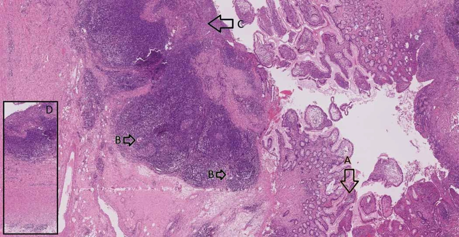 Small intestine with Crohn’s disease – A. architectural distortion of mucosa, B. giant cells, C. ulceration,
D. transmural inflammation.<br>
Obr. 3. Tenké střevo postižené Crohnovou nemocí – A. distorze architektoniky sliznice, B. mnohojaderné buňky, C. ulcerace,
D. transmurální zánět.