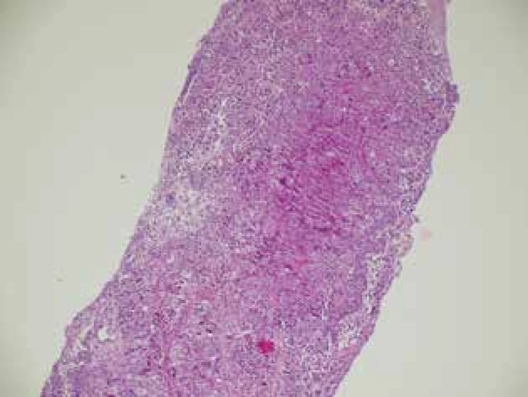 Karcinom prsu před NT (histologický preparát) <br>Fig. 4: Breast carcinoma before NT (histological sample)
