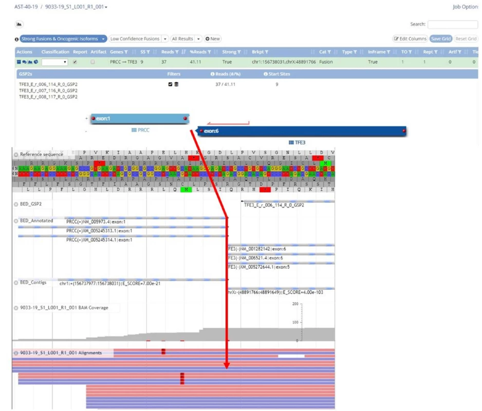 Translokační Xp11 (TFE3-PRCC) renální karcinom. Výstup z NGS: fúze genů PRCC/TFE3<br>
Fig. 3. Xp11 (TFE3-PRCC) translocation renal cell carcinoma. NGS analysis: fusion of genes PRCC/TFE3 