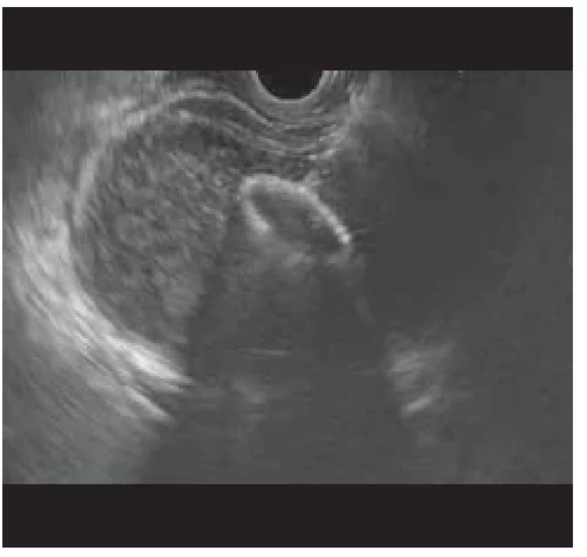 EUS zobrazení rozvinuté distální
fl ange ve žlučníku. <br> 
Fig. 2. EUS imaging of the developed distal
fl ange in the gallbladder.