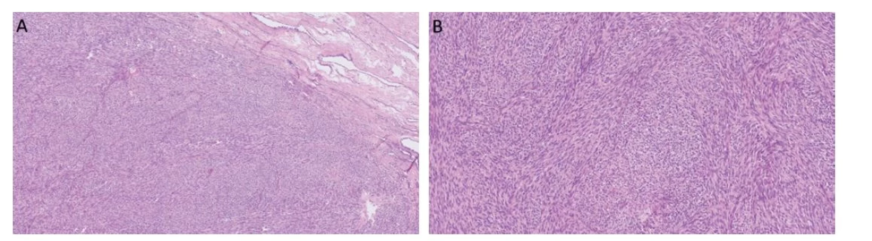 Myoidní gonadální stromální tumor roste solidně, je celulární a často se vyskytuje v blízkosti rete testis (A). Nádorové buňky jsou vřetenité
a fascikulárně uspořádané (B).