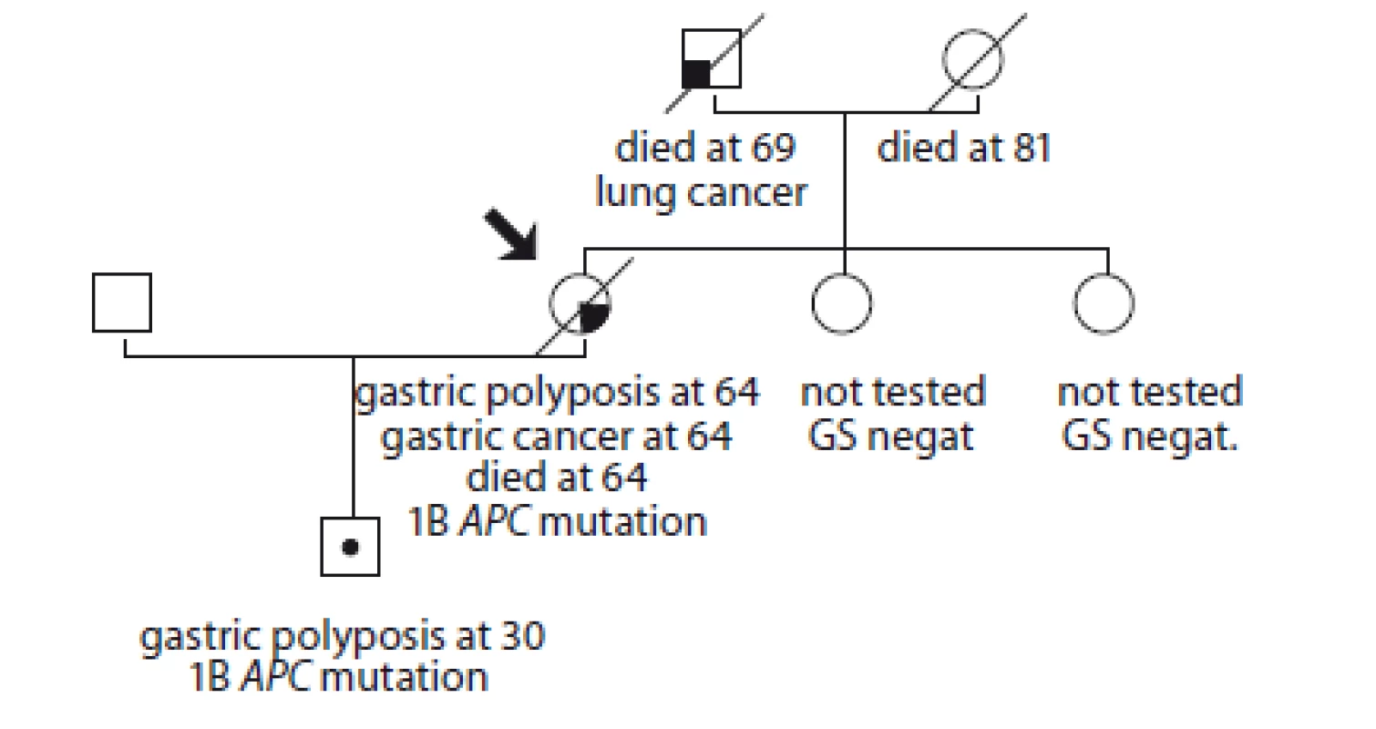 Pedigree of family no. 1 (Masaryk Memorial Cancer Institute).<br>
GS – gastroscopy