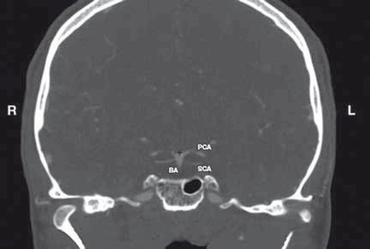 Determination of the BAB. Coronal reconstruction of CTA of the head.<br>
BA – basilar artery; BAB – basilar artery bifurcation; L – left; R – right; PCA – posterior cerebral artery; SCA – superior cerebellar artery<br>
+ a marker<br>
Obr. 1. Určení BAB. Koronární rekonstrukce CTA hlavy.<br>
BA – bazilární arterie; BAB – bifurkace bazilární arterie; L – vlevo;
PCA – arteria cerebri posterior; R – vpravo; SCA – arteria cerebelli
superior
+ označení