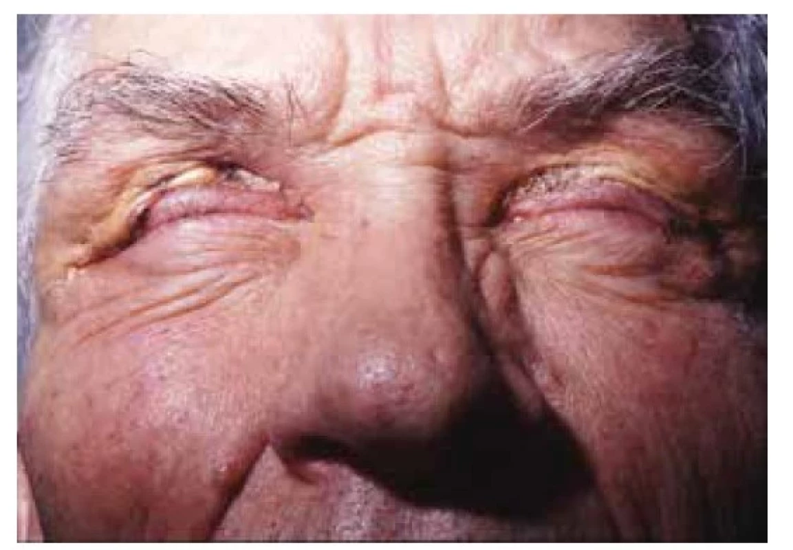 Xanthogranuloma necrobioticum
