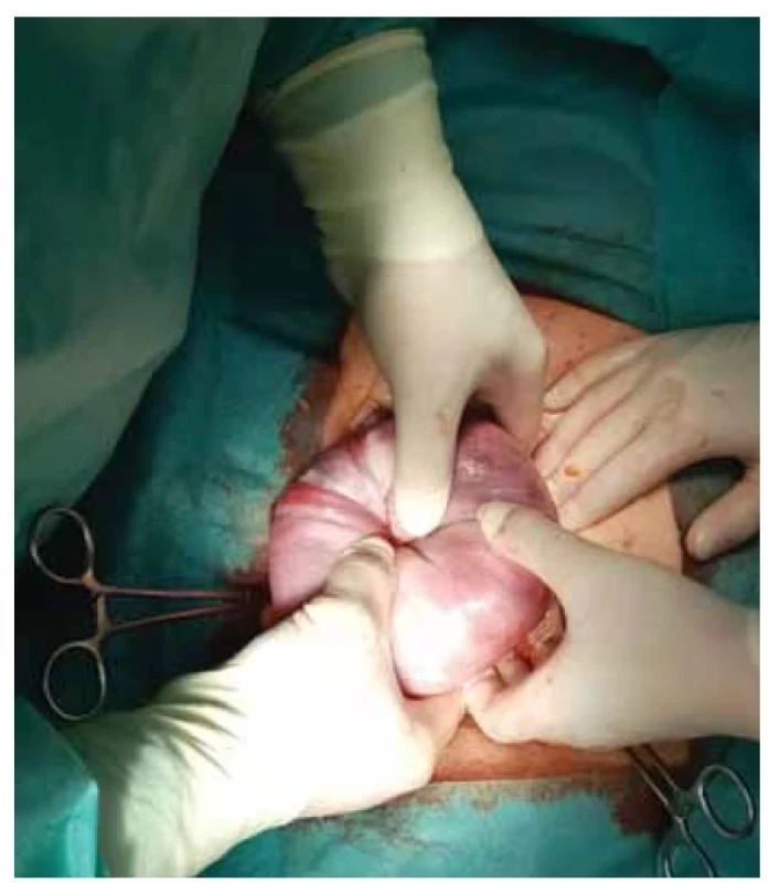 Laparotomická repozice, modifikace Huntigtonovy
metody (zdroj: archiv autorů).<br>
Fig. 2. Laparotomy reduction, modification of Huntington’s
method (source: authors’ archive).
