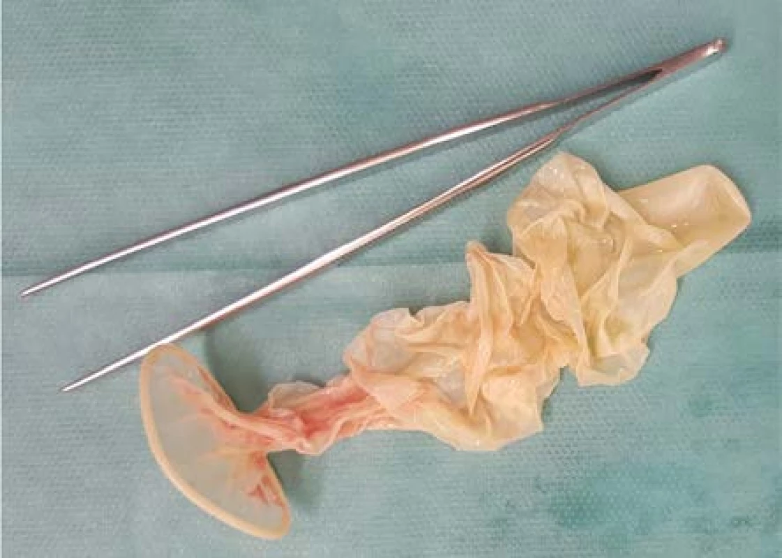 Prezervativ extrahovaný endoskopicky z močového
měchýře (foto autor MUDr. Petr Kajfosz – KNTB,
a. s., Zlín urologické oddělení)<br>
Fig. 1. A condom removed endoscopically from the
urinary bladder (Photo by Petr Kajfosz, MD – Tomáš
Baťa Regional Hospital in Zlín, Department of Urology)