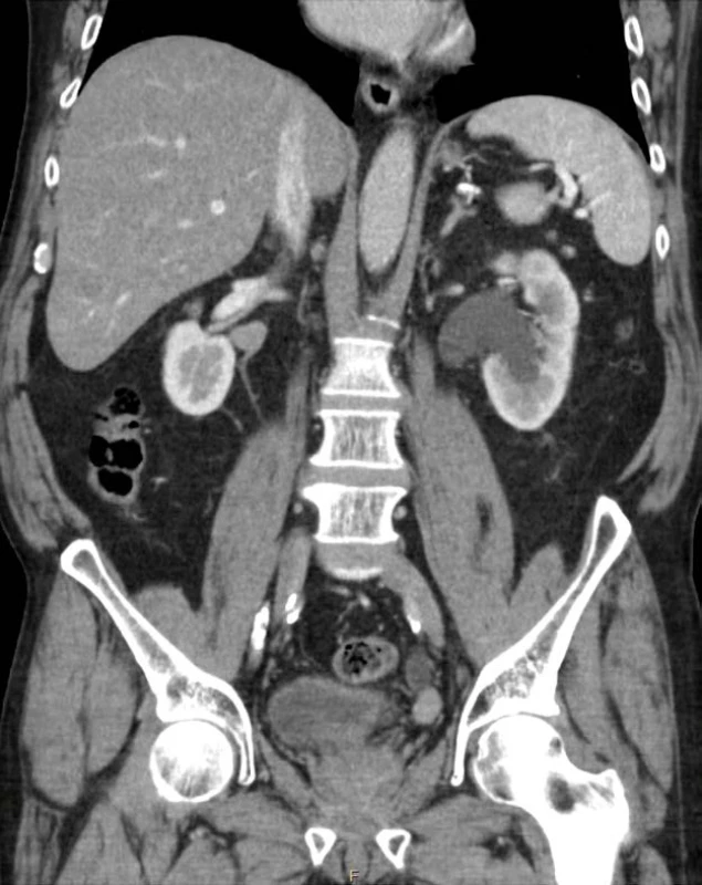 CT-IVU – tumor distálního
močovodu vlevo na koronárním řezu
(zdroj: Krajská zdravotní, a. s.)<br>
Fig. 2. CT-IVU – tumor of left distal
ureter (frontal plane)