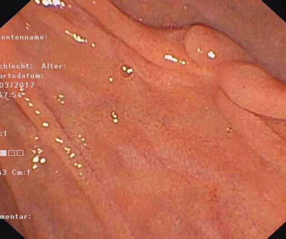 Jazva po polypektómii.<br> Fig. 9. Postpolypectomy scar.