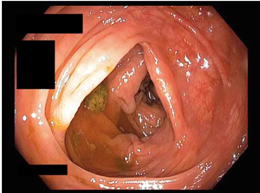 Kvalita střevní přípravy dle BBPS – hodnocení
2 body.<br>
Fig. 2. Quality of intestinal preparation according to BBPS –
2 points.<br>
BBPS – Boston Bowel Preparation Scale