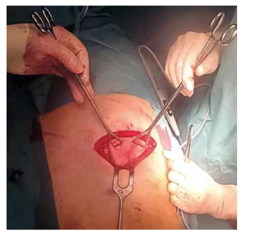 Herniace plicní tkáně defektem hrudní stěny<br>
Fig. 3: Herniation of the lung tissue through the chest
wall defect