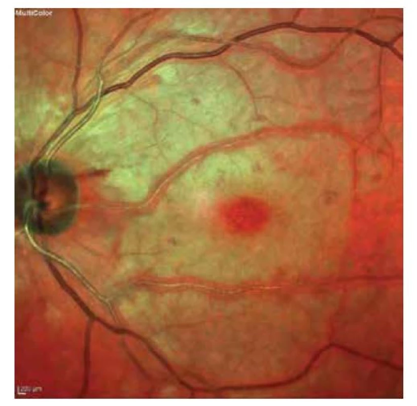 Bledý vzhled sítnice s třešňovou skvrnou v makule
– příznaky CRAO trvající 6,5 hodiny<br>
CRAO – central retinal artery occlusion