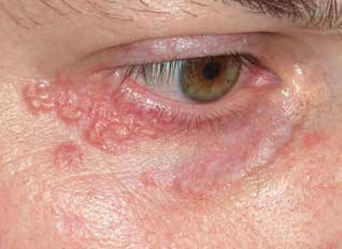 Lupus miliaris disseminatus faciei